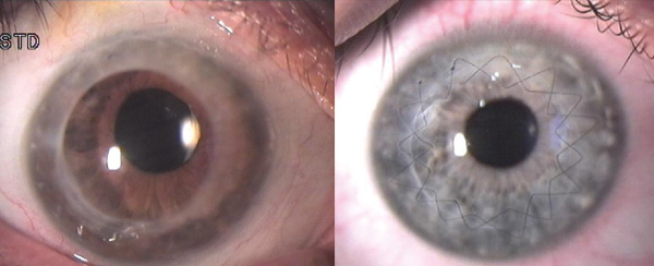 keratoplastik