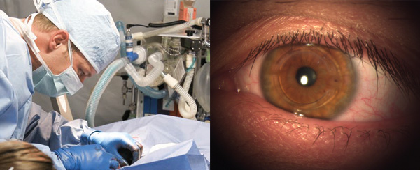 lasik